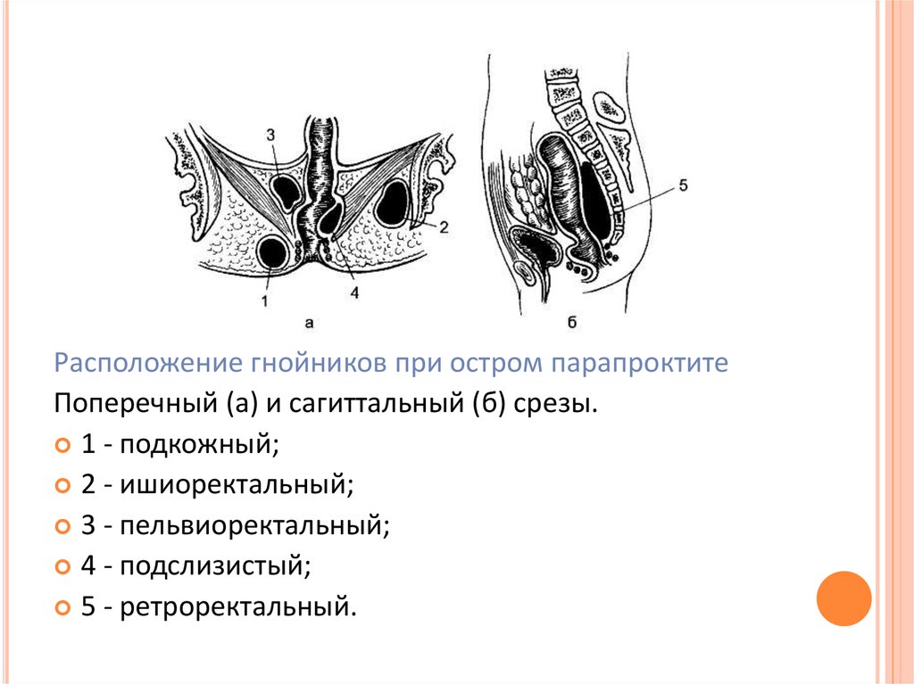 Парапроктит это. Острый парапроктит классификация. Острый Гнойный парапроктит классификация. Пельвиоректальный парапроктит операция. Острый ретроректальный парапроктит.