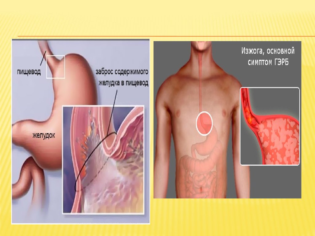 Симптомы эзофагита. Забрасывание содержимого желудка в пищевод. Гастроэзофагеальная боль. Гастроэзофагеальный заброс. Гастроэзофагеальный рефлюкс основной.