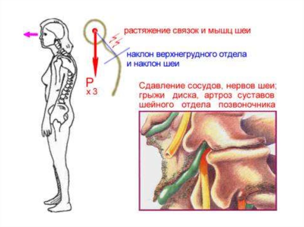 Боли при наклоне вперед. Нагрузка на позвоночник при наклоне головы. Нагрузка на позвонки при наклоне головы. Нагрузка на шею при наклоне. Болит шея при наклоне вперед.