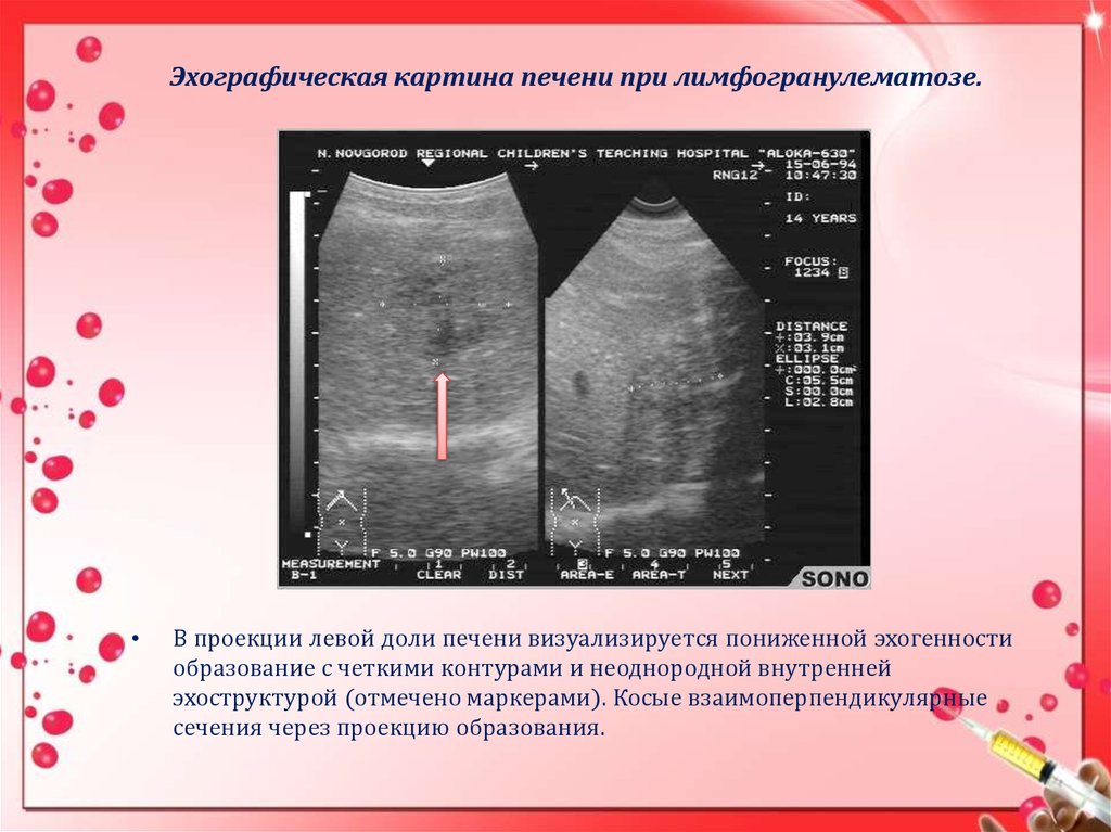 Эхографическая картина. Лимфогранулематоз печени УЗИ. Эхографическая картина печени при лимфогранулематозе. УЗИ при лимфогранулематозе. Лимфогранулематоз УЗИ картина.