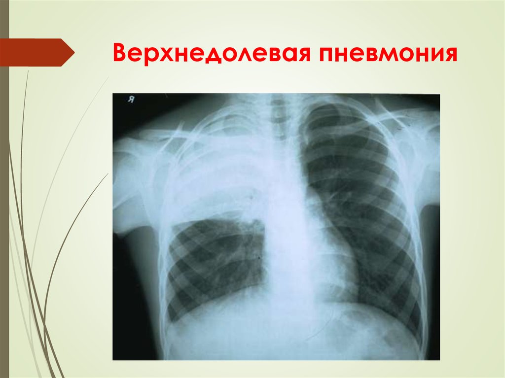 Верхнедолевая пневмония. Рентген пневмококковой крупозной пневмонии. Верхнедолевая пневмония справа рентген. Долевая пневмония рентгенограмма. Очагово сливная пневмония рентген.