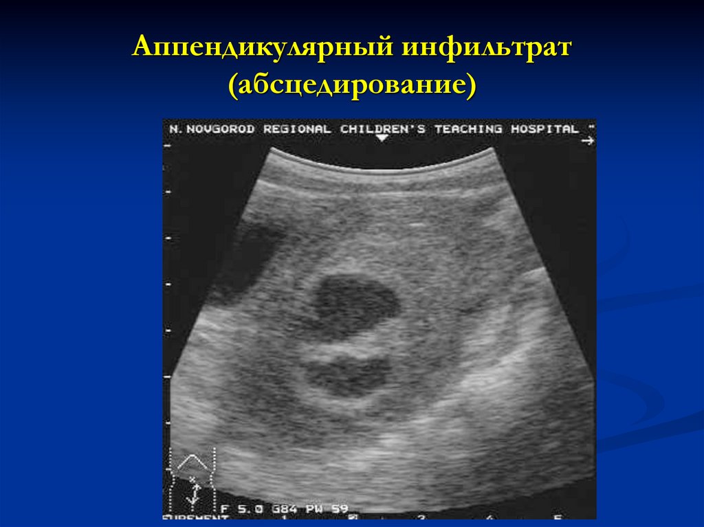 Узи аппендицита. Аппендикулярный инфильтрат. Периаппендикулярный инфильтрат. Аппендикулярный инфильтрат и абсцесс. Аппендэктомия инфильтрат.