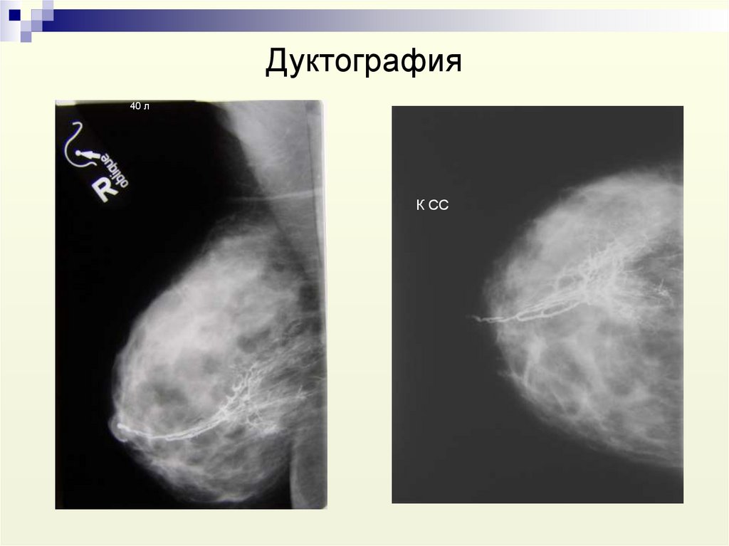 Дуктография молочной железы. Внутрипротоковая дуктография. Дуктография молочной железы показания. Внутрипротоковая папиллома дуктография. Маммография дуктография.