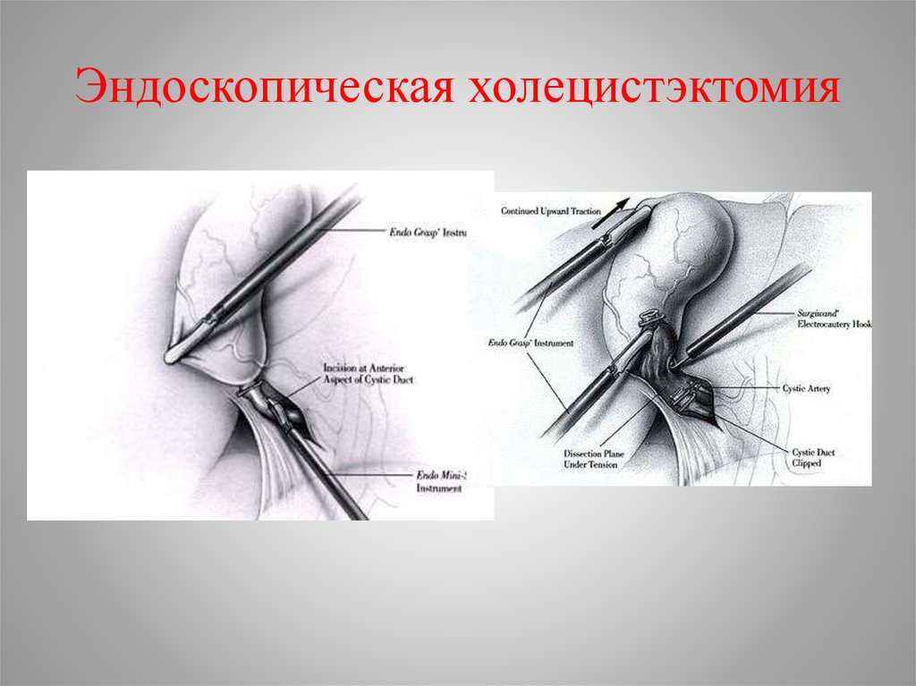 Перенесенная холецистэктомия. Лапароскопическая холецистэктомия этапы. Эндоскопическая холецистэктомия. Эндоскопия холецистэктомия. Холецистэктомия этапы операции.