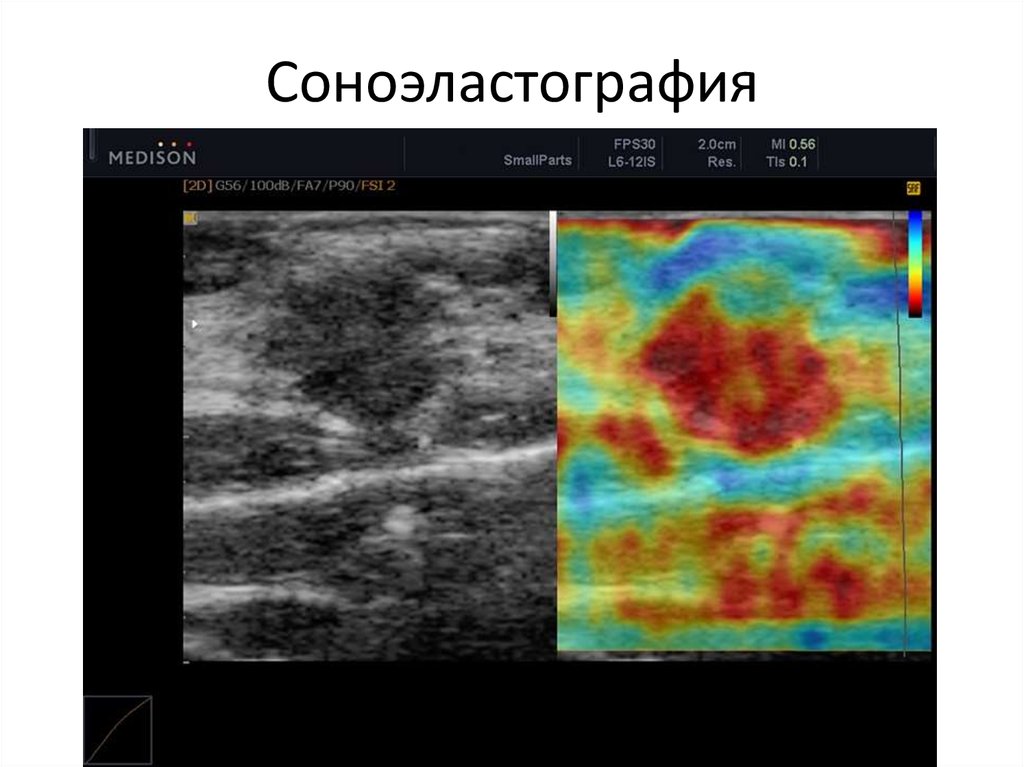 Узи молочных желез дни. Ультразвуковая компрессионная эластография. Соноэластография УЗИ молочной железы. Эластография лимфатических узлов. УЗИ С эластографией молочных желез.