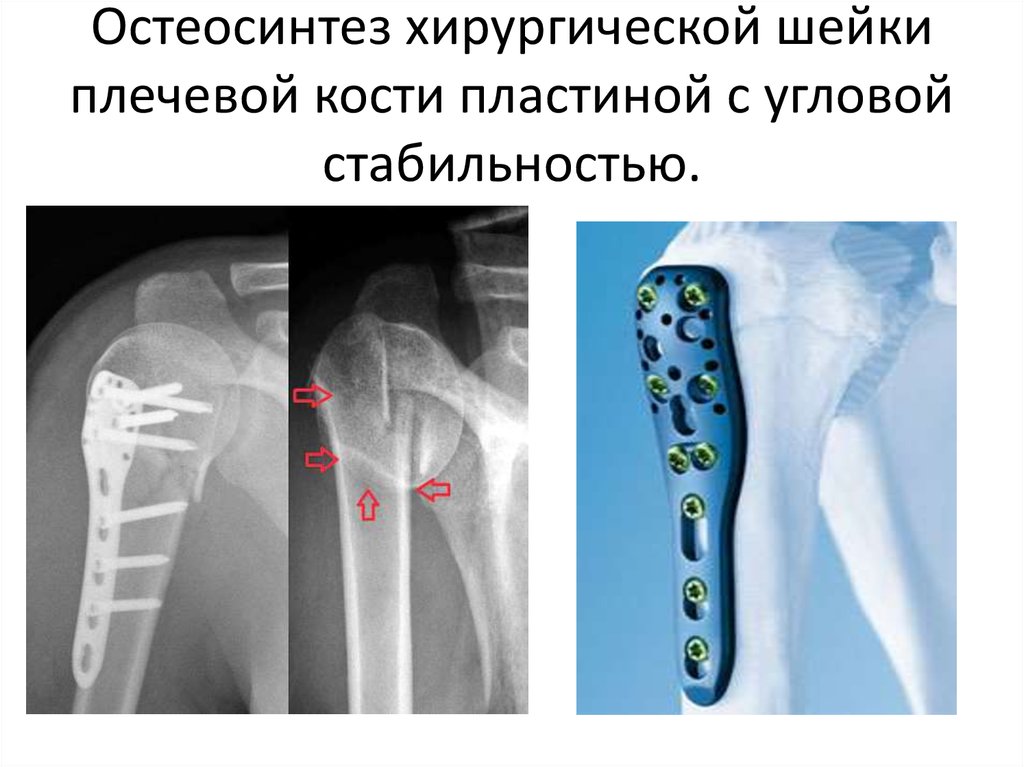 Хирургическая кость. Накостный остеосинтез плеча. Накостный остеосинтез титановой пластины .. Остеосинтез шейки плечевой кости. Накостный остеосинтез диафиза плечевой кости.