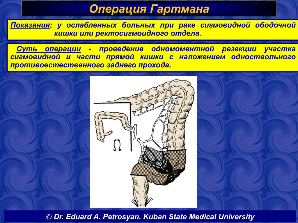 Операция толстой. Операция Гартмана на прямой кишке. Колостома операция Гартмана. Операция Гартмана на сигмовидной кишке. Передняя резекция прямой кишки по Гартману.