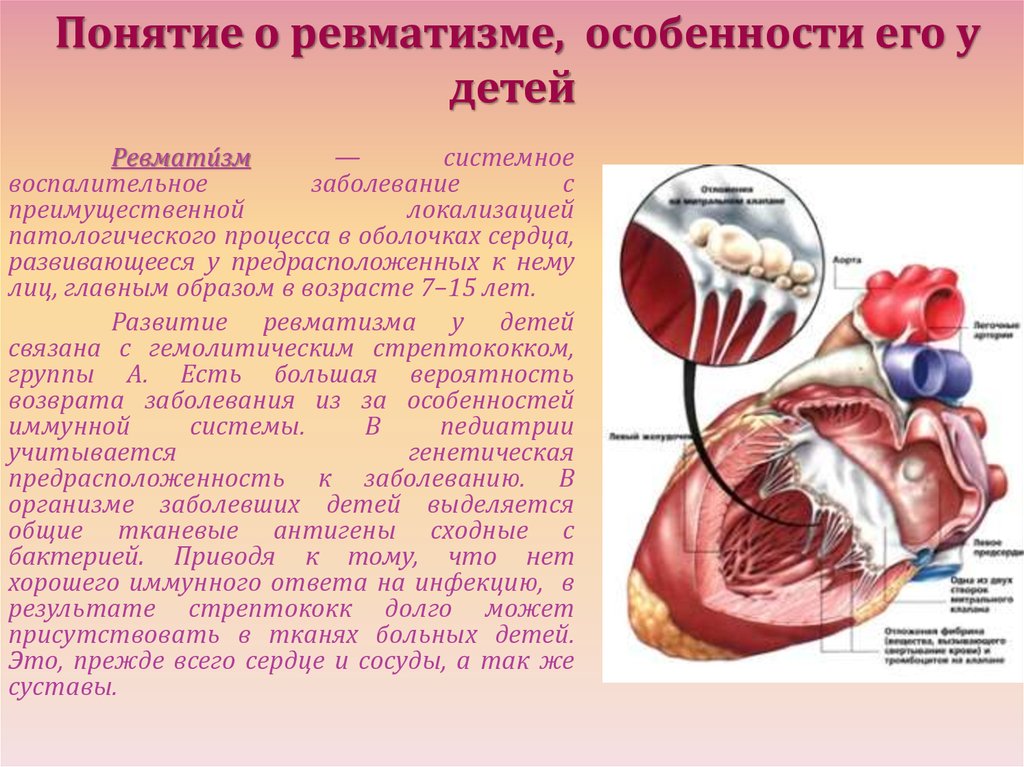 Ревмокардит