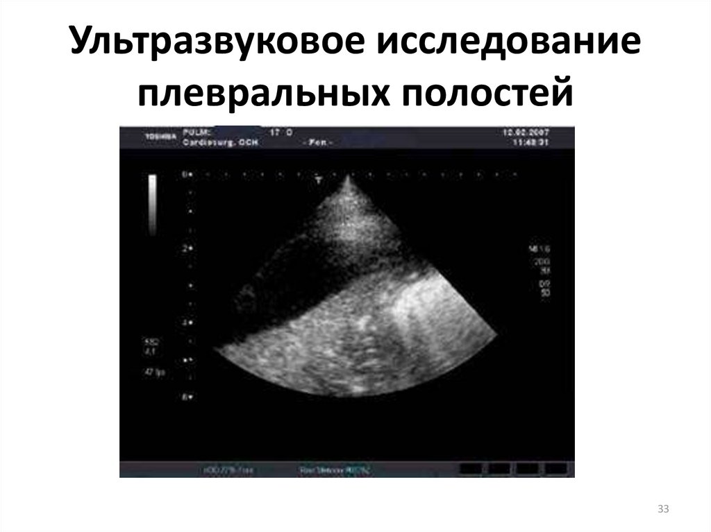 Назначено узи. Диагностер УЗИ плевральных полостей. УЗИ плевральных полостей плеврит. Жидкость в плевральной полости на УЗИ. Плевральный выпот на УЗИ.