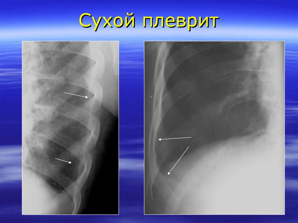 Экссудативный плеврит рентгенологическая картина