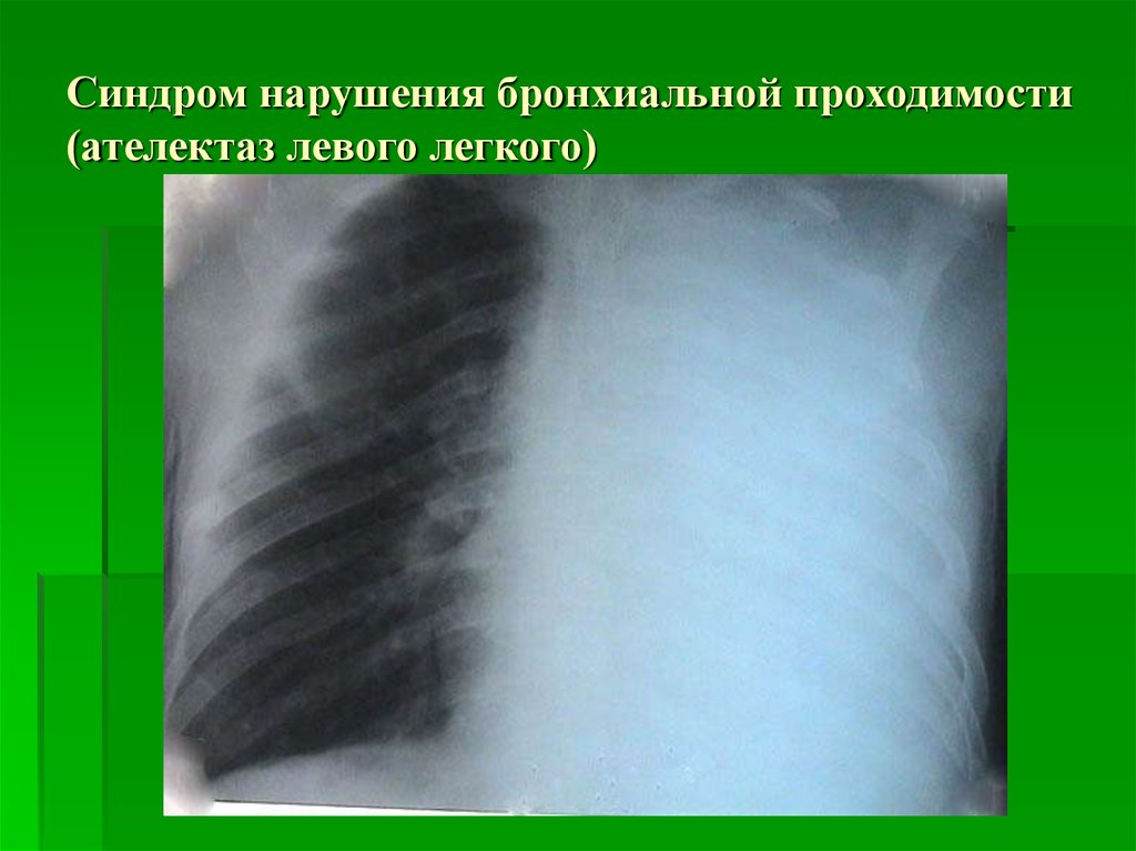 Нарушение проходимости. Нарушение бронхиальной проходимости рентген. Синдром нарушения бронхиальной проходимости рентген. Нарушение проходимости бронхов. Лёгкие нарушения бронхиальной проходимости.