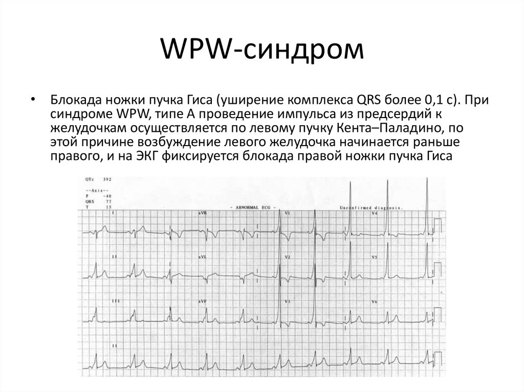 Wpw синдром на экг фото