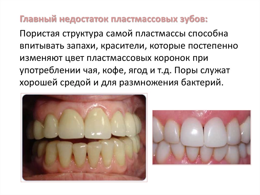 Пластмассовые коронки презентация