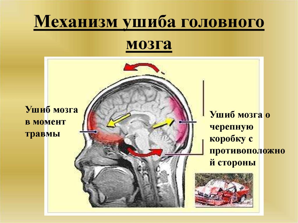 Закрытые травмы головы. Механизмы ушиба головного мозга.