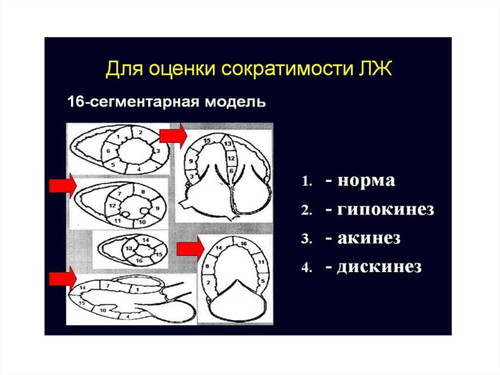 Акинез передней стенки