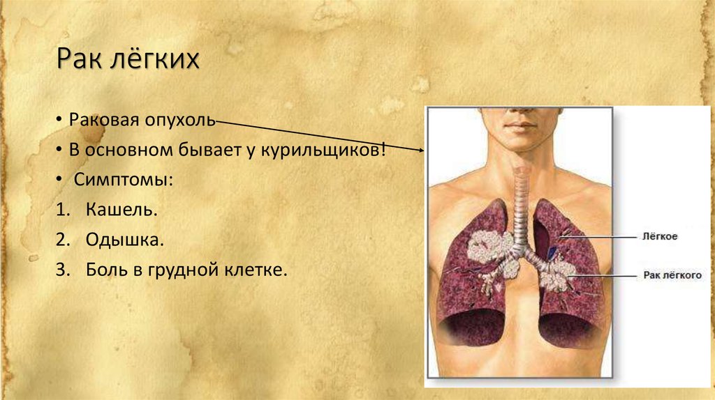 Причины легкого. Опухоли дыхательных органов симптомы. Реферат заболевание легких по биологии. Болезни лёгких биология 8. Сообщение по биологии на тему онкология дыхание.