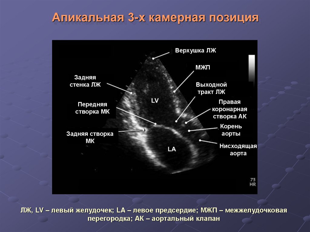 Стенки лж на эхокг