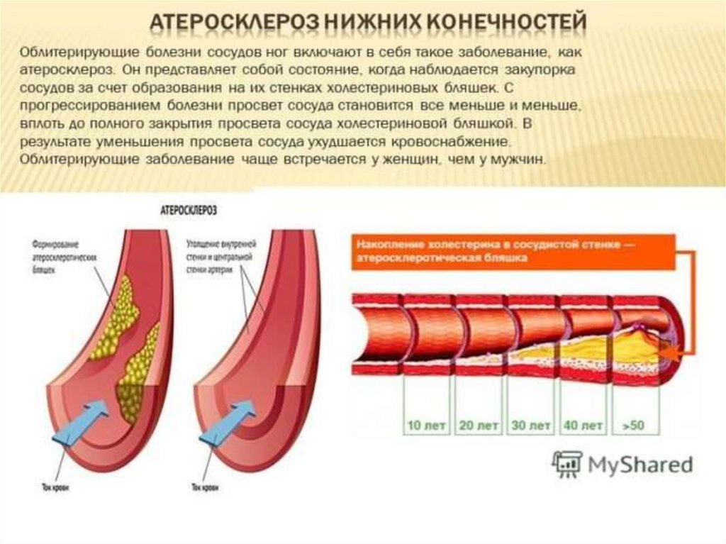 Заболевание сосудов. Атеросклеротические поражения артерий хирургия. Атеросклеротическое поражение сосудов. Локализации атеросклероза артерий конечностей. Облитерирующий атеросклероз сосудов нижних конечностей.