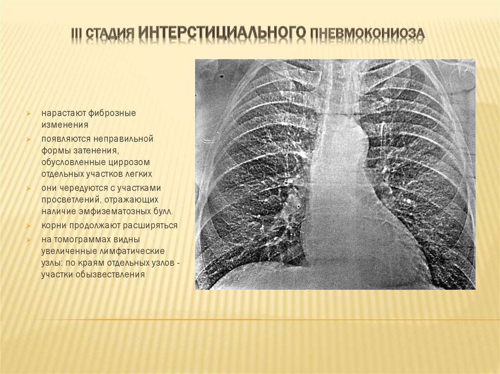 Картина фиброзных изменений. Узелковая форма пневмокониоза. Рентген классификация пневмокониоза. Пневмокониоз узелковая форма рентген. Пневмокониоз легких 1 стадия рентген.