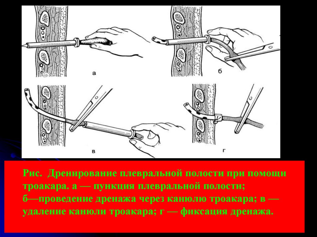 Пункция полостей. Троакар Бюлау. Дренирование плевральной пункции. Соберите инструментарий для дренирования плевральной полости. Методика дренирования плевральной полости.