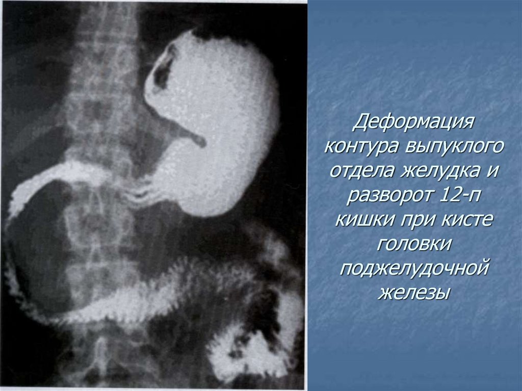 Киста пищевода. Рентгеноскопия желудка и 12 перстной кишки. Киста поджелудочной железы рентген. Дивертикул двенадцатиперстной кишки рентген. Опухоль головки поджелудочной железы рентген.
