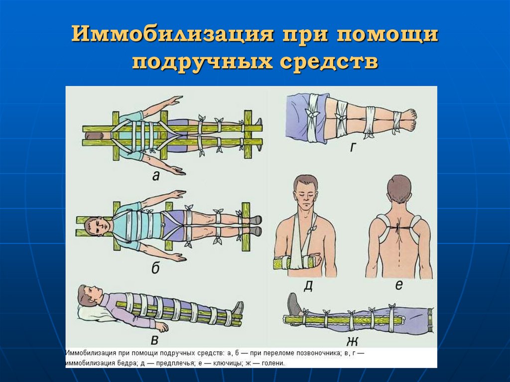 Каким образом производится иммобилизация пострадавшего. Транспортная иммобилизация при травме позвоночника алгоритм. Транспортная иммобилизация военнослужащих. Принципы транспортной иммобилизации. Иммобилизация при помощи подручных средств.