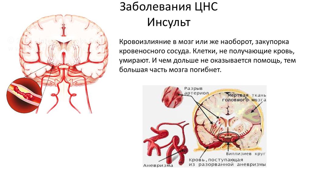 Поражение центрального нерва