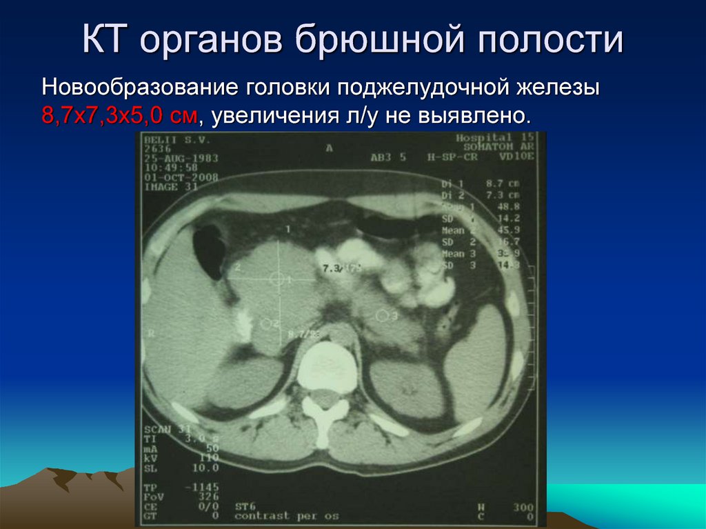 Кт органов. Кт органов брюшной полости. Компьютерная томограмма брюшной полости. Органы брюшной полости кт опухоли.