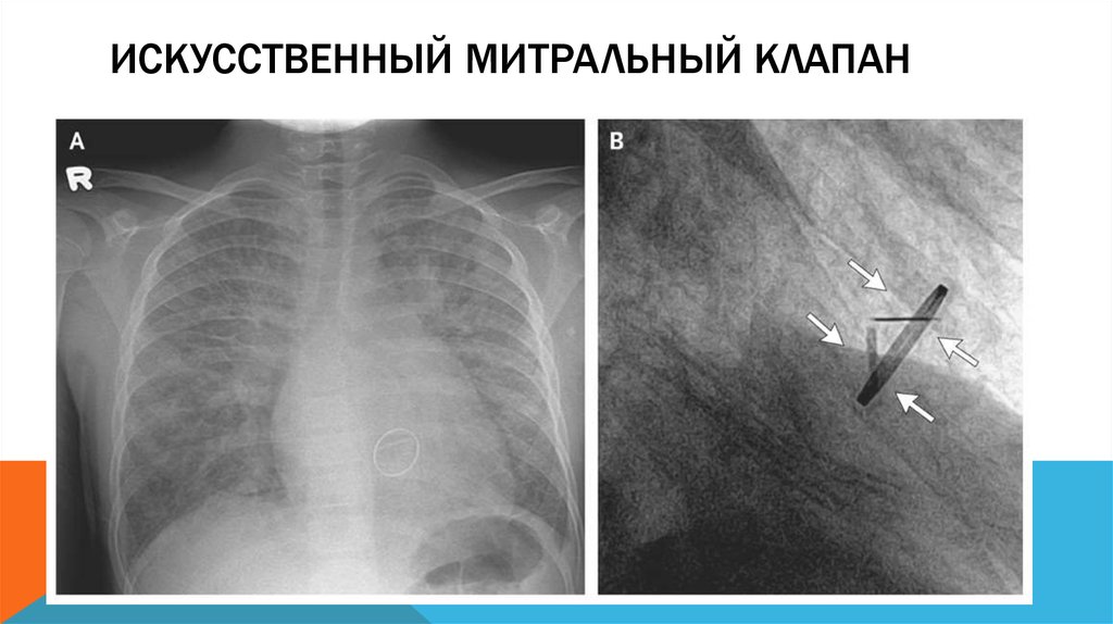 Операция клапана. Протез митрального клапана рентген. Митральный клапан рентген. Протез аортального клапана рентген. Искусственный митральный клапан рентген.