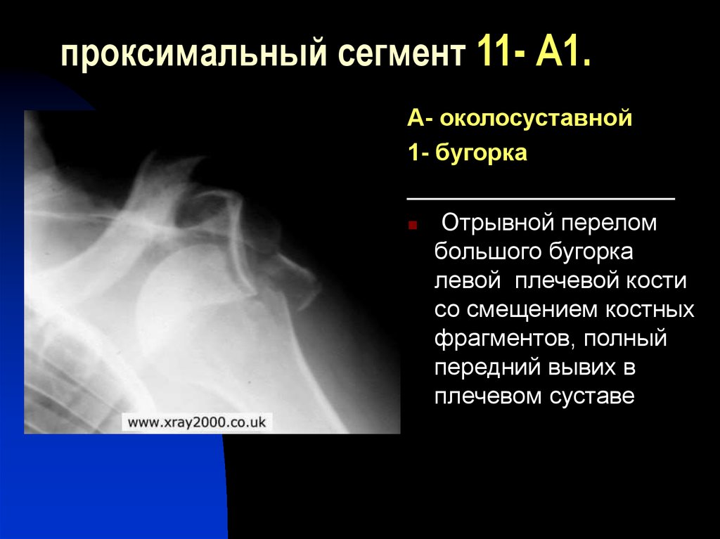 Перелом большого бугорка плечевой кости реабилитация