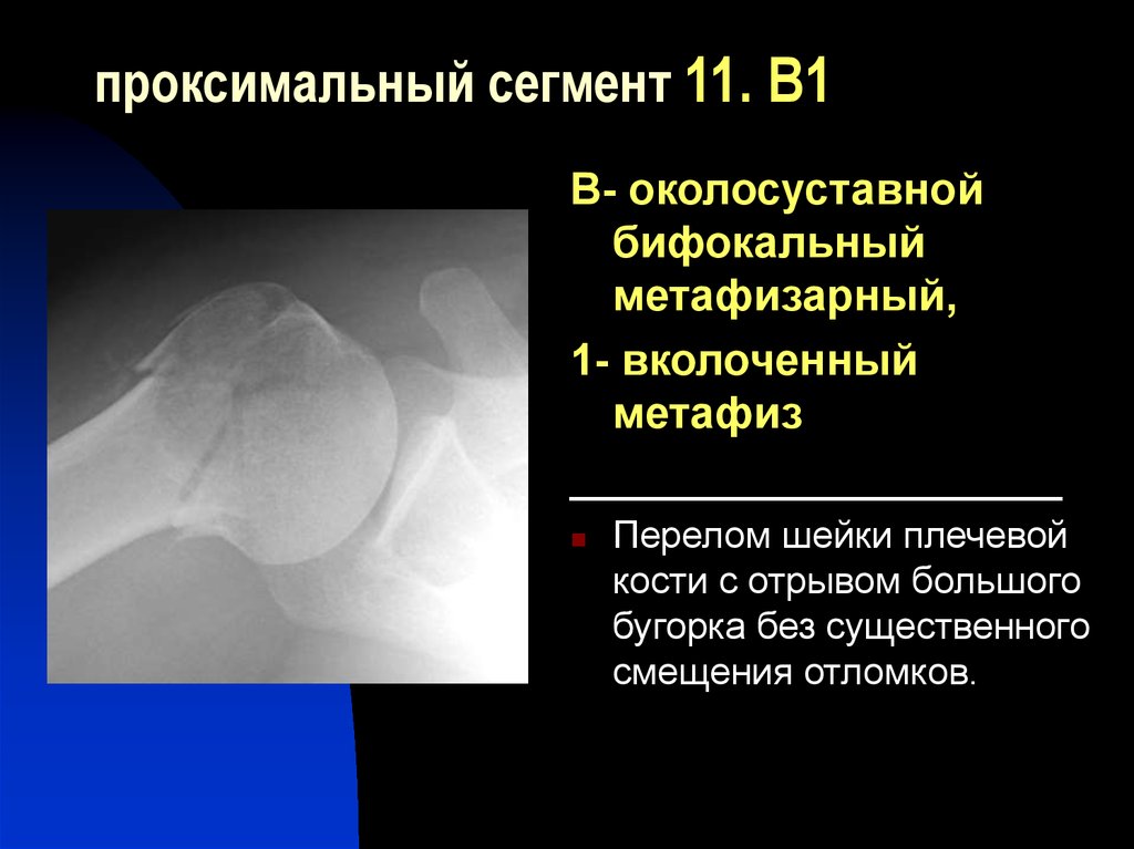 Закрытый перелом плечевой кости. Чрезмыщелковый перелом плечевой кости мкб. Перелом плечевой кости код по мкб. Перелом головки плечевой кости по мкб 10. Перелом плечевого сустава код по мкб 10.