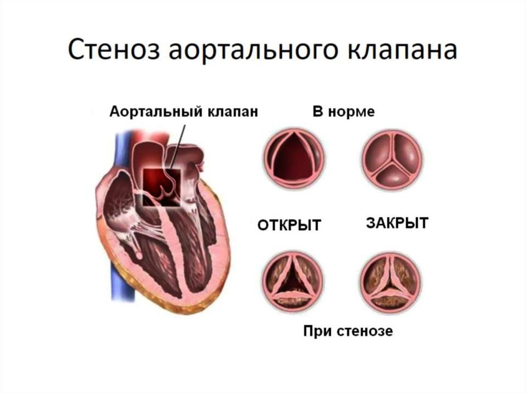 Сердечный стеноз. Порок сердца стеноз аортального клапана. Стеноз двустворчатого аортального клапана. Стеноз устья аорты классификация степени.