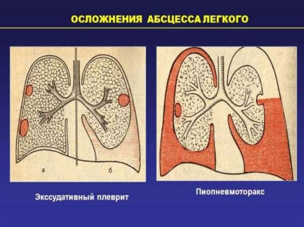 Абсцесс прогноз. Строение абсцесса легкого.