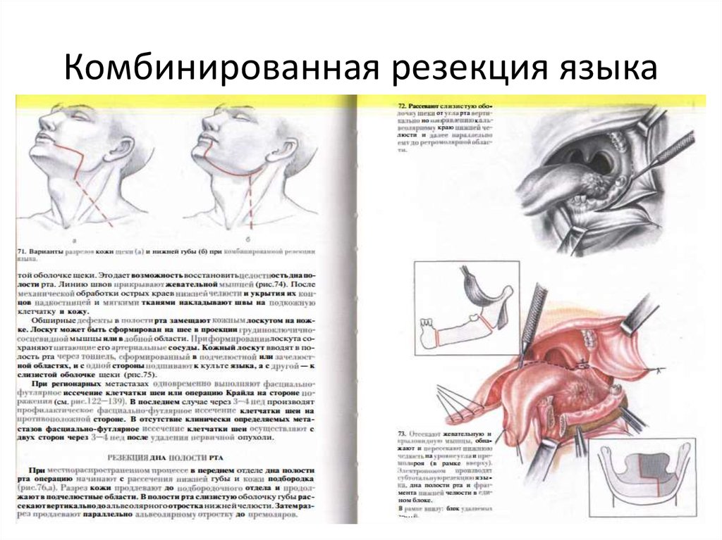 Резекция дао фото