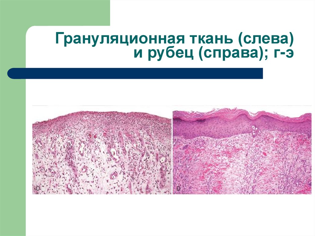 Гранулез. Грануляционная ткань патанатомия. Грануляционная ткань микро. Микропрепоат грануляционнная теань.