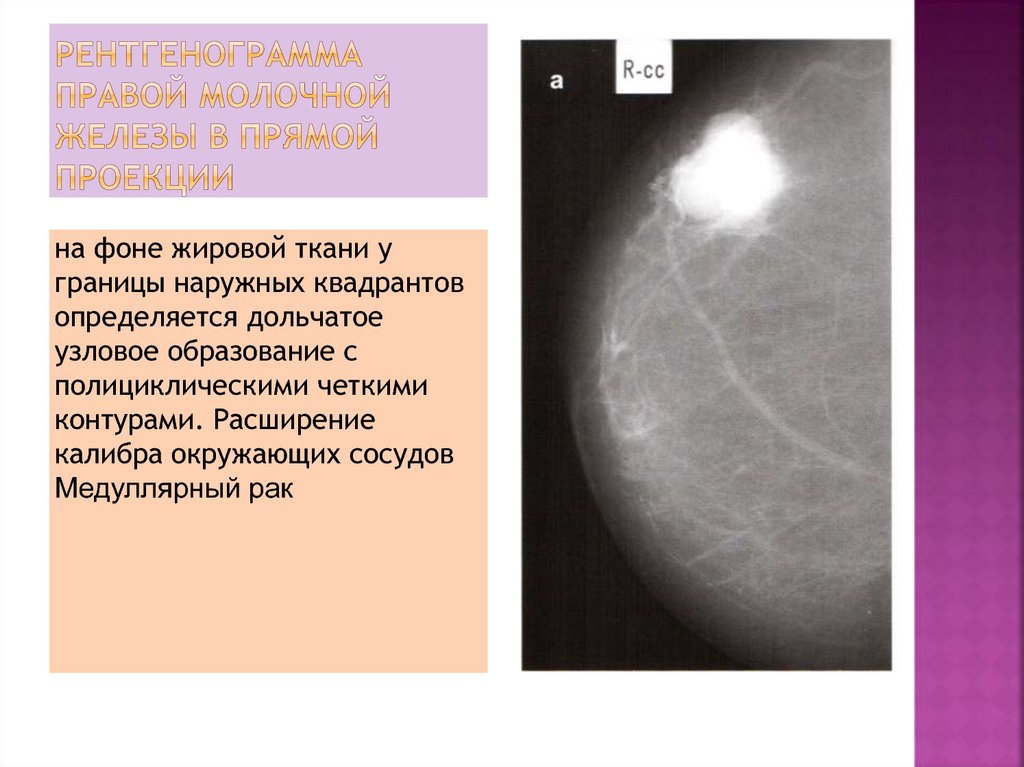 Фиброзно жировая инволюция молочных желез