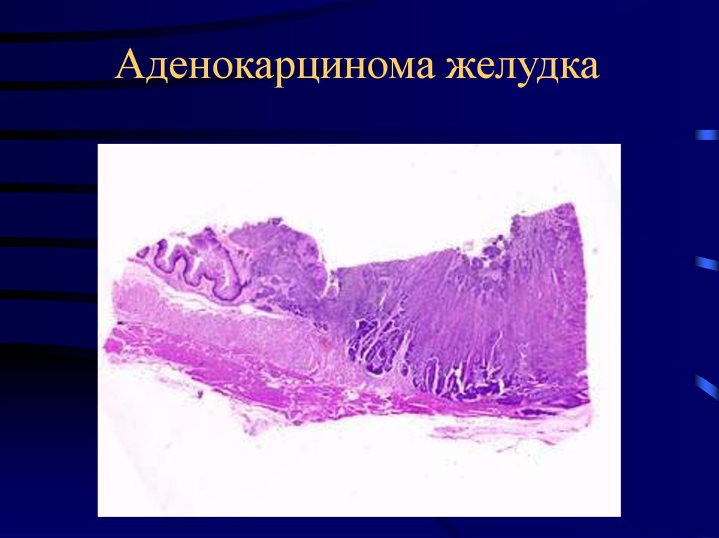 Аденокарцинома желудка. Аденокарцинома желудка макропрепарат. Макропрепараты язвенная болезнь желудка. Низкодифференцированная аденокарцинома желудка g3 это. Аденокарцинома желудка Патан.