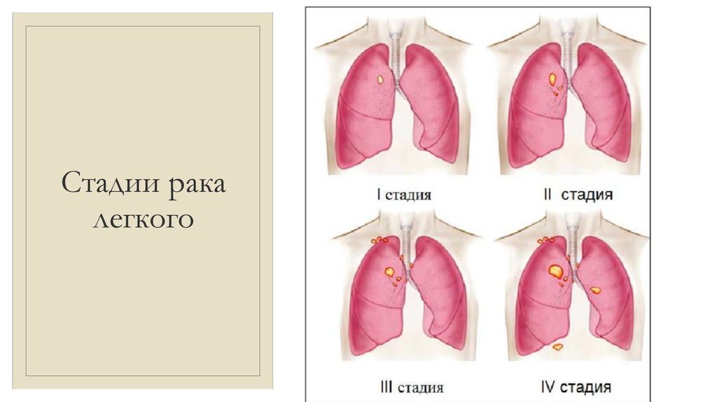 4 стадия злокачественная. Стадии онкологии легкого. Онкология лёгких 4 стадия. Онкология легких стадии.