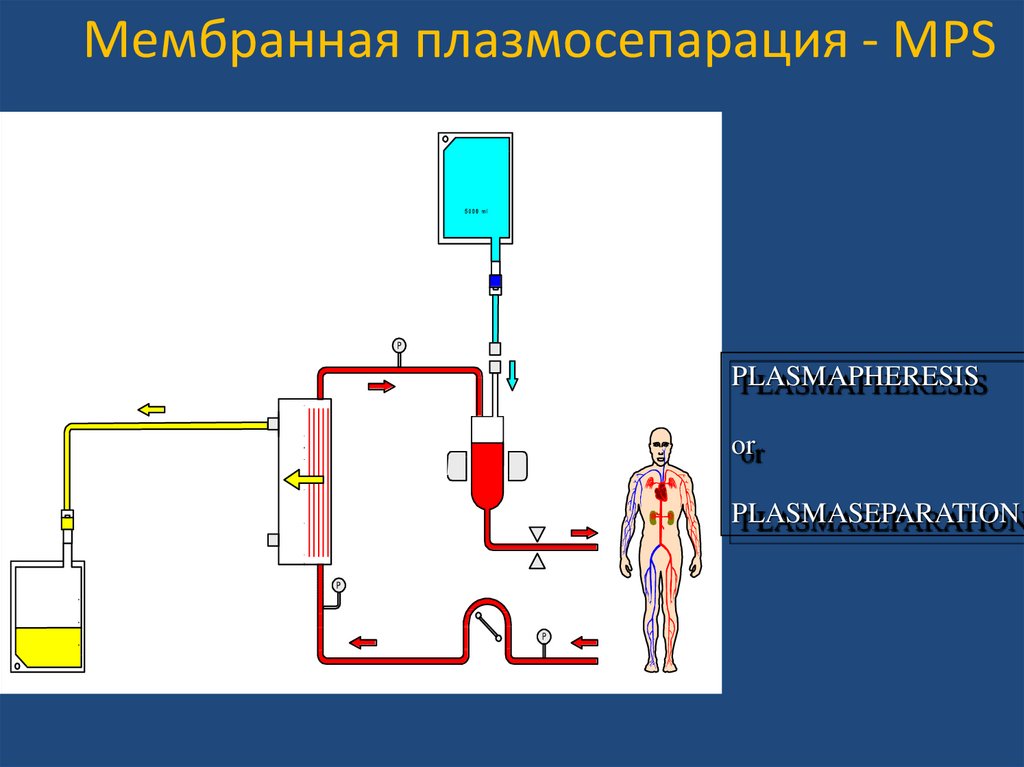 Плазмаферез это простыми словами