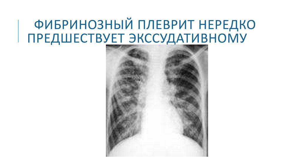 Экссудативный плеврит при пневмонии. Сухой фибринозный плеврит рентген. Костальный плеврит рентген. Сухой плеврит на рентгенограмме.