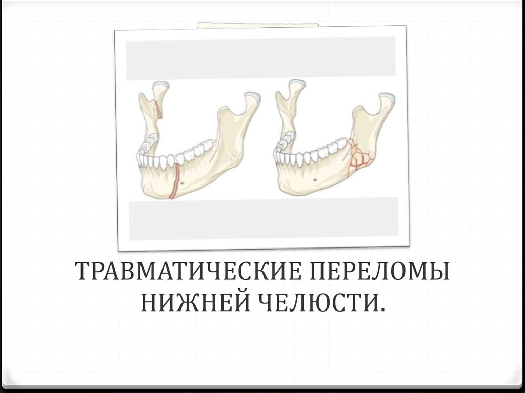 Перелом нижней. Травматический перелом нижней челюсти. Травматические переломы челюсти. Поперечный перелом нижней челюсти. Двухсторонний перелом нижней челюсти.