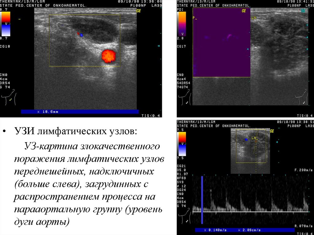 Узи лимфоузлов. УЗИ лимфатических узлов норма. УЗИ лимфатических узлов торакальной локализации. Патология лимфатических узлов на УЗИ. Ультразвуковое исследование лимфатических узлов одна анатомическая.
