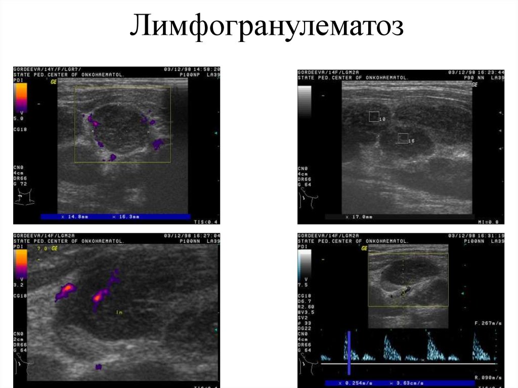 Лимфома Шеи На Узи Фото