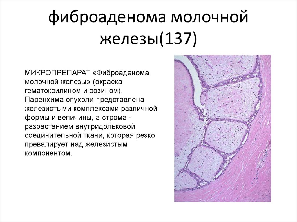 Фиброаденома молочной железы презентация