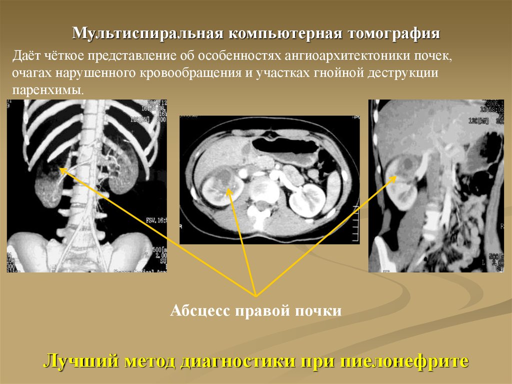 Мскт почек. Острый пиелонефрит компьютерная томография. Кт почек при остром пиелонефрите. Хронический пиелонефрит кт.