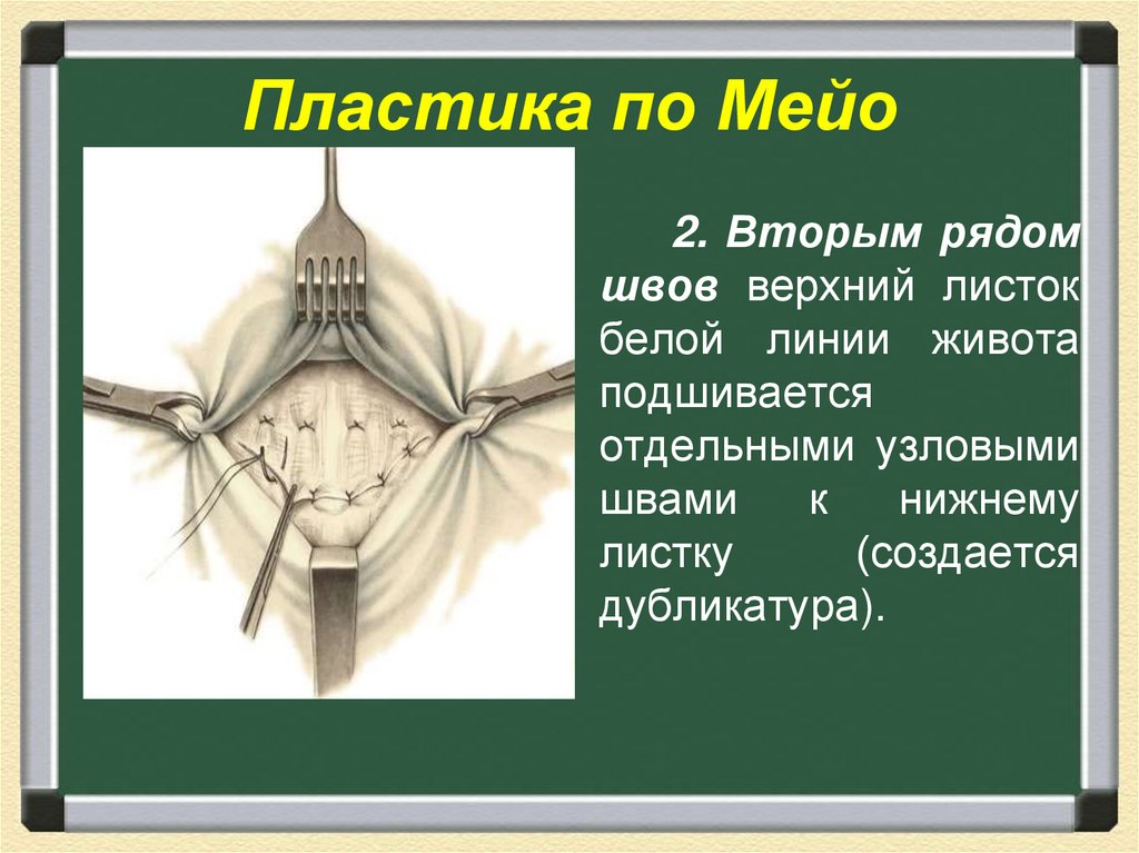 Пластика по мейо картинки