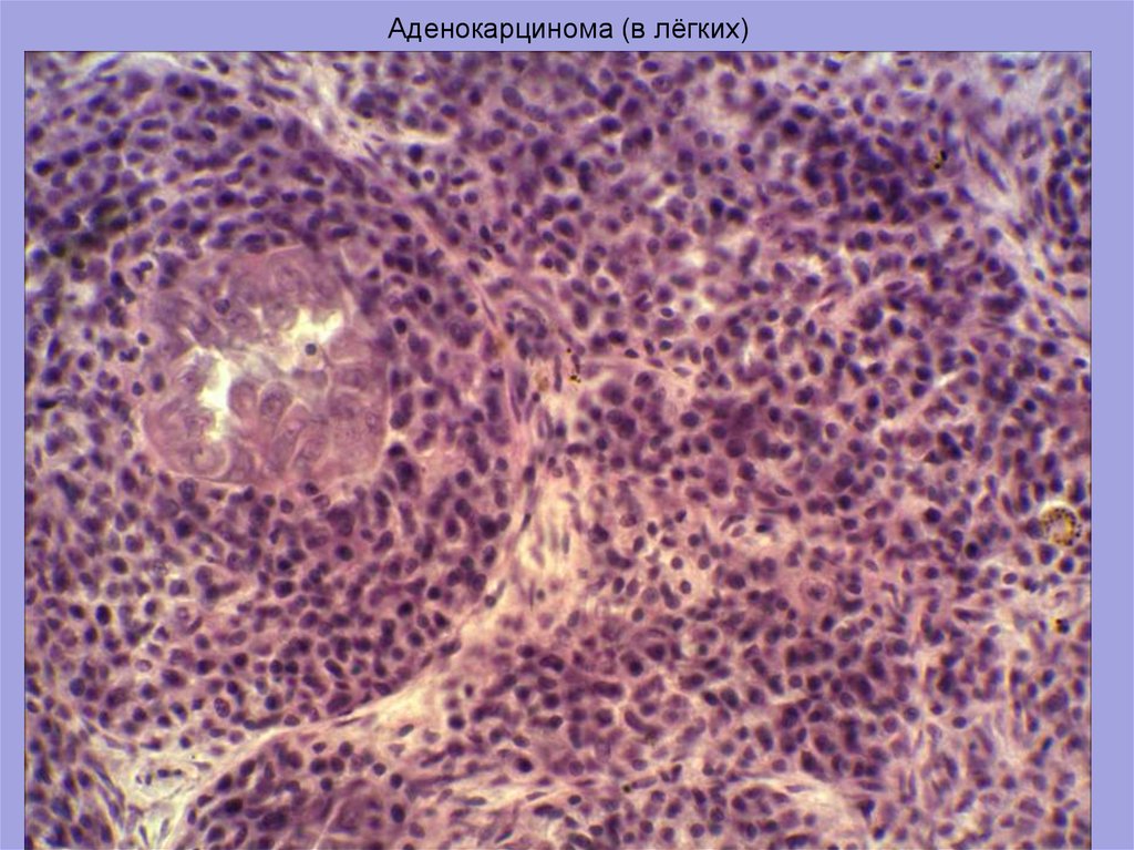 Аденокарцинома это. Аденокарцинома легких микропрепарат. Ацинарная аденокарцинома легкого. Аденокарцинома макроскопически. Низкодифференцированная аденокарцинома легкого.