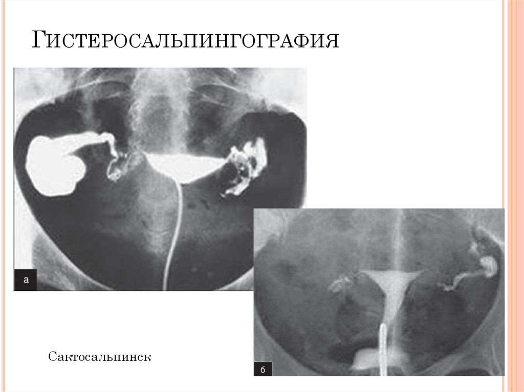 Гсг. Гистеросальпингография. Гистеросальпингография на фотографиях.