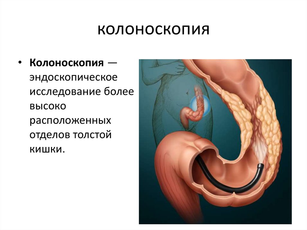 Эндоскопическое исследование толстой кишки