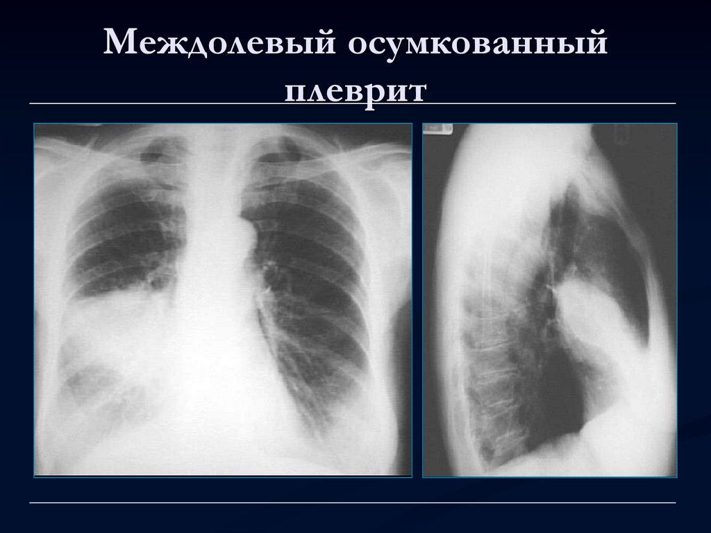 Экссудативный плеврит рентгенологическая картина